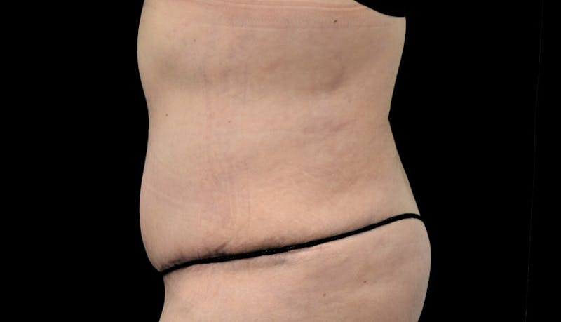 Massive Weight Loss Before & After Gallery - Patient 102563717 - Image 6