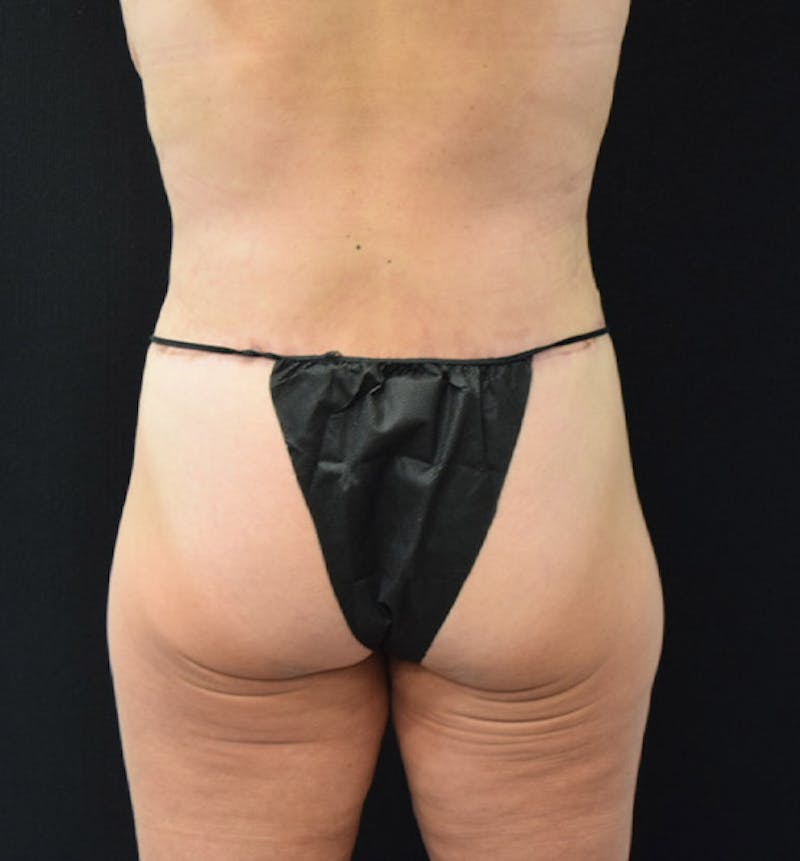Lower Body Lift Before & After Gallery - Patient 102457163 - Image 12