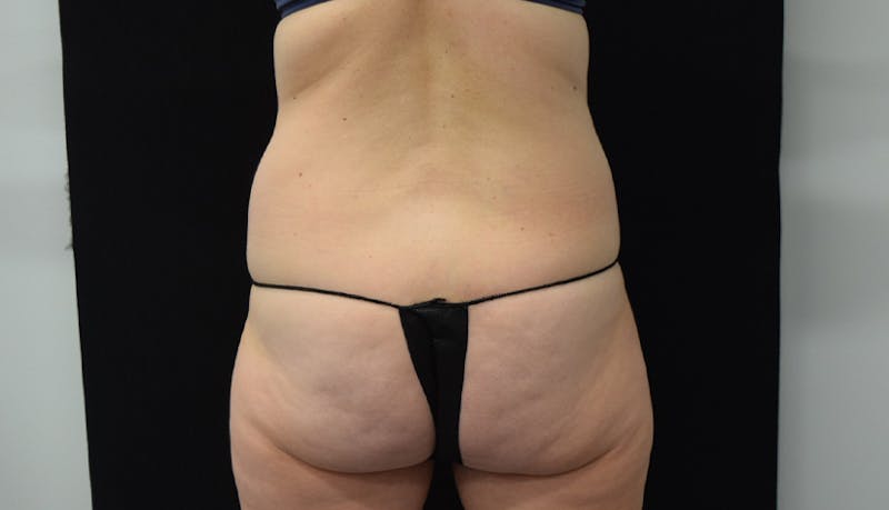 Abdominoplasty Before & After Gallery - Patient 102468564 - Image 9