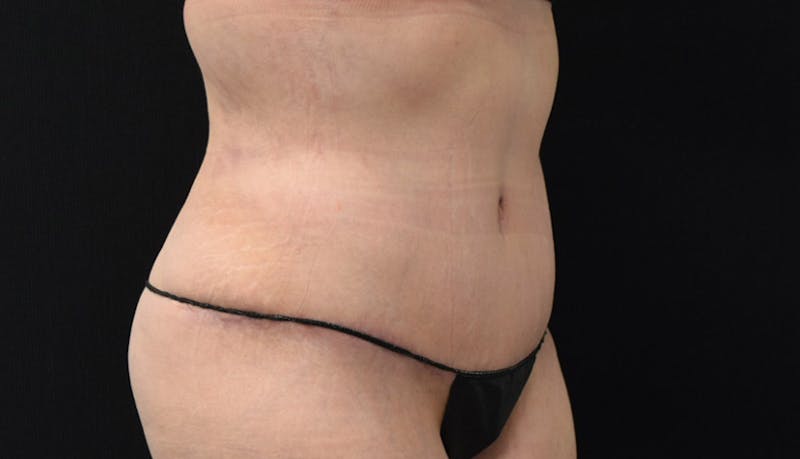 Massive Weight Loss Before & After Gallery - Patient 102563717 - Image 8