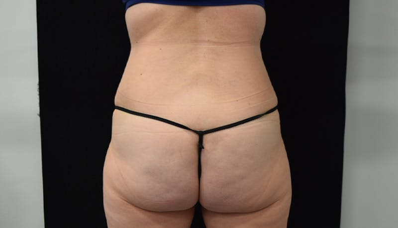 Abdominoplasty Before & After Gallery - Patient 102468564 - Image 10