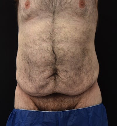 Male Lower Body Lift Before & After Gallery - Patient 148037528 - Image 1