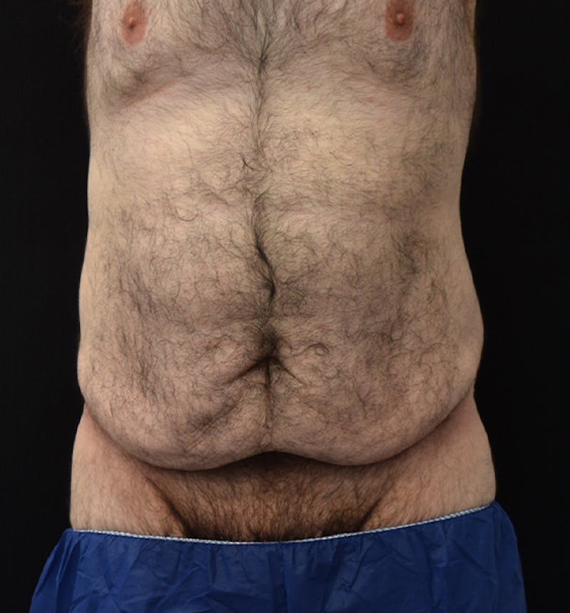 Lower Body Lift Before & After Gallery - Patient 148037528 - Image 1