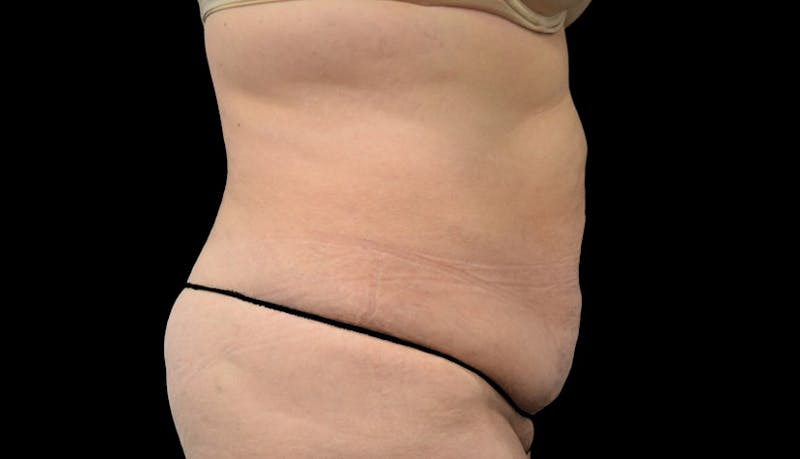 Massive Weight Loss Before & After Gallery - Patient 102563717 - Image 9