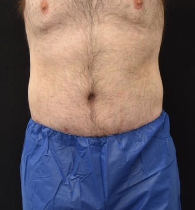 Male Lower Body Lift Before & After Gallery - Patient 148037528 - Image 2