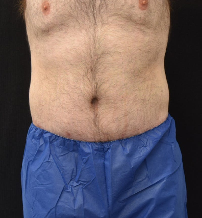Male Lower Body Lift Before & After Gallery - Patient 148037528 - Image 2