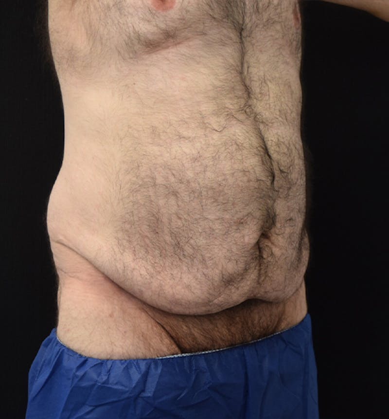 Male Lower Body Lift Before & After Gallery - Patient 148037528 - Image 3