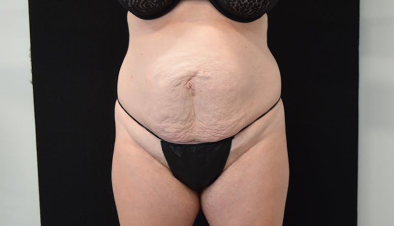 Abdominoplasty Before & After Gallery - Patient 102563751 - Image 1