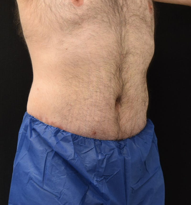 Male Lower Body Lift Before & After Gallery - Patient 148037528 - Image 4