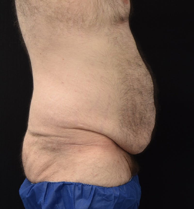 Male Lower Body Lift Before & After Gallery - Patient 148037528 - Image 5