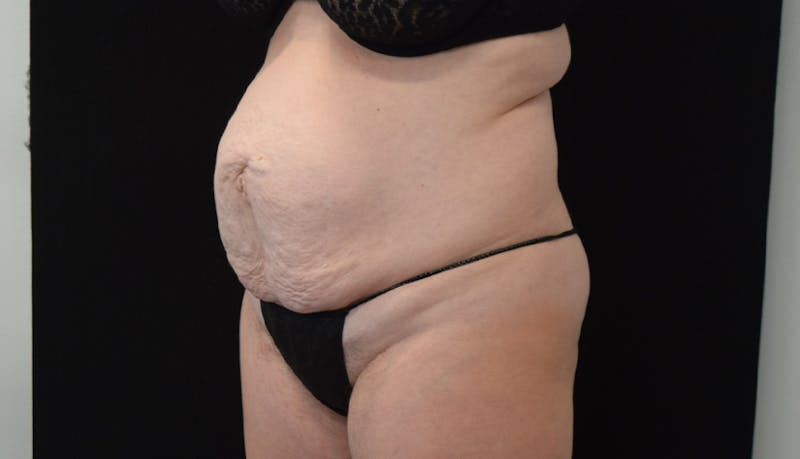 Abdominoplasty Before & After Gallery - Patient 102563751 - Image 3