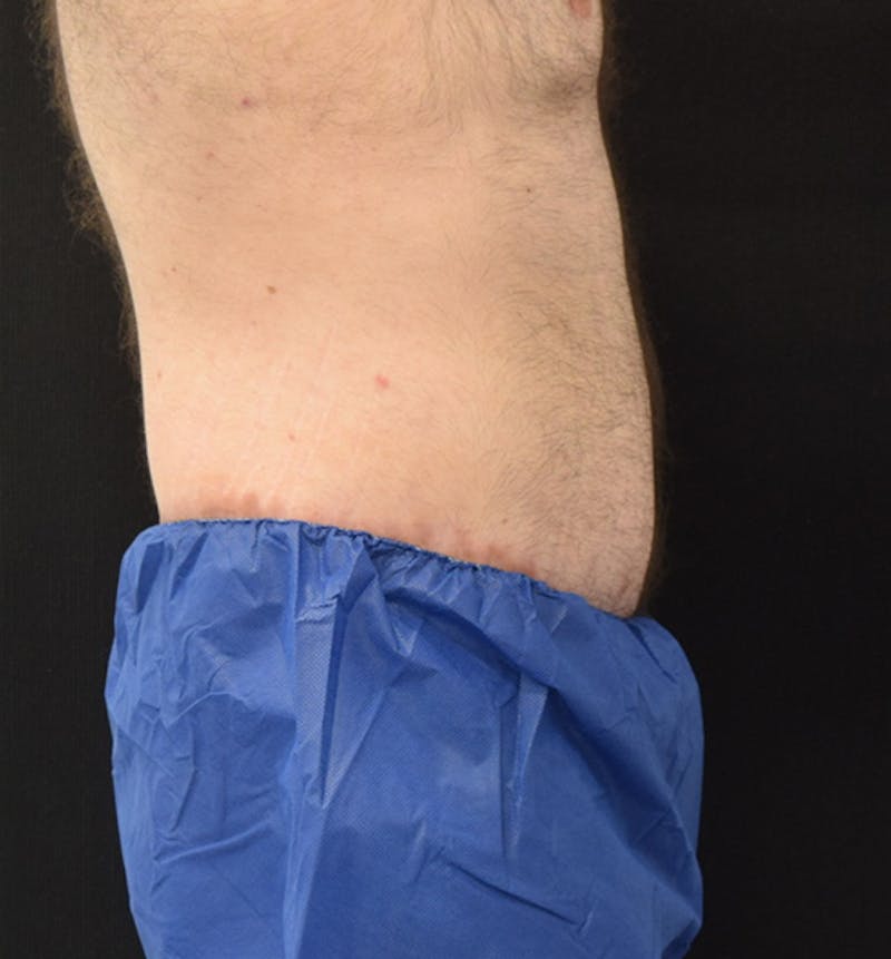 Male Lower Body Lift Before & After Gallery - Patient 148037528 - Image 6