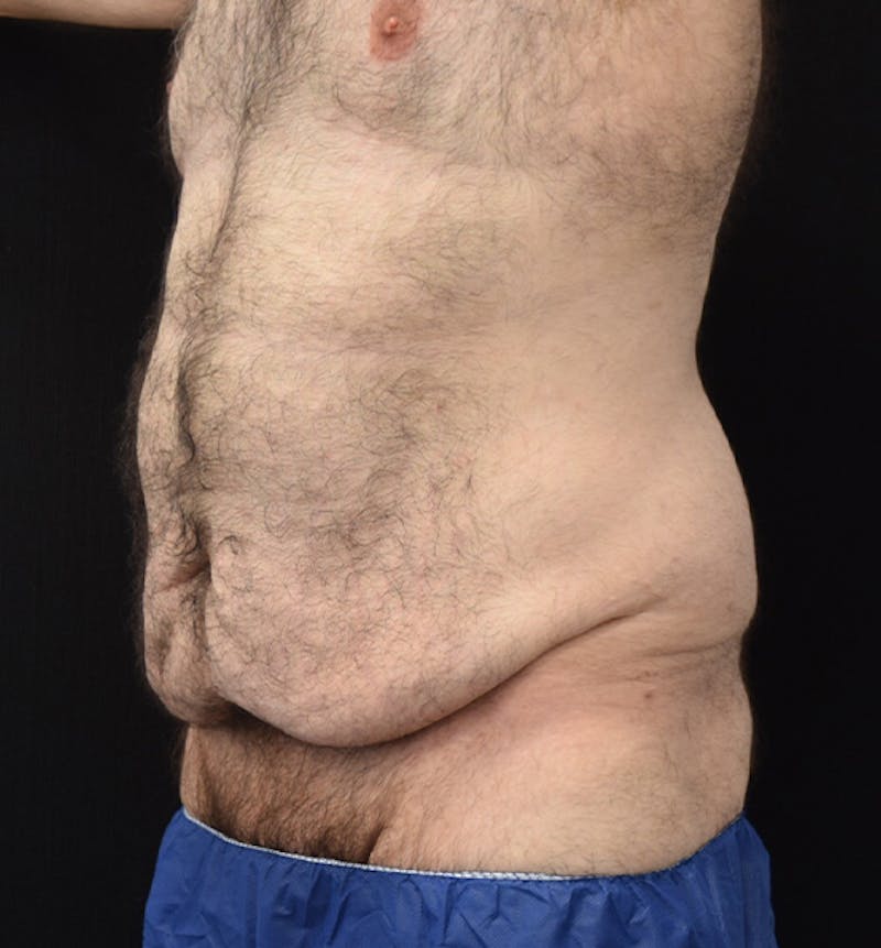 Male Lower Body Lift Before & After Gallery - Patient 148037528 - Image 7