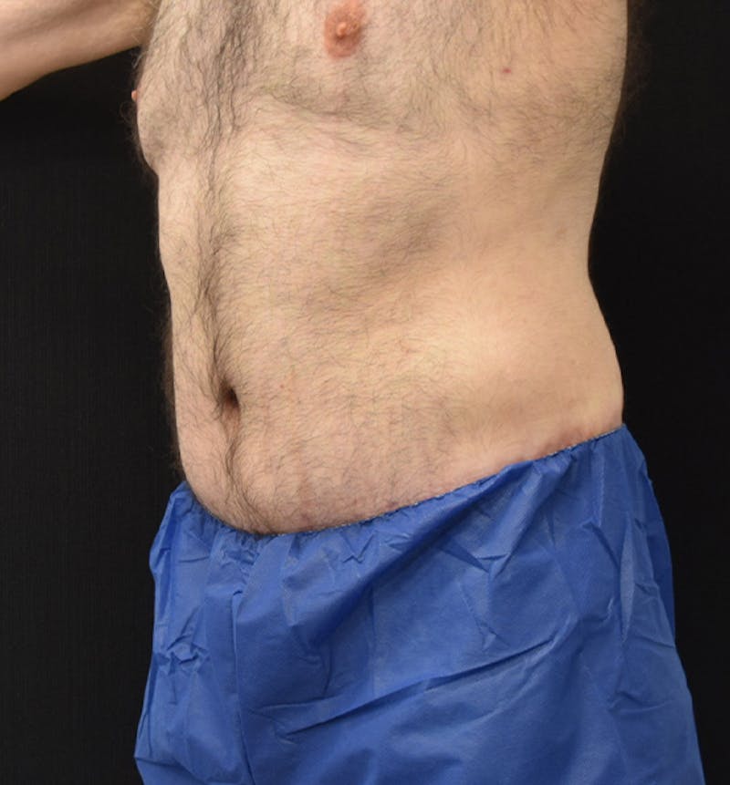 Male Lower Body Lift Before & After Gallery - Patient 148037528 - Image 8