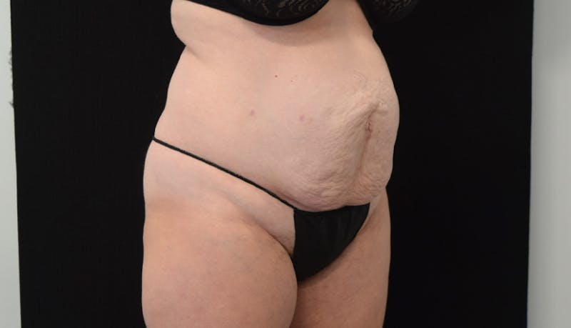 Abdominoplasty Before & After Gallery - Patient 102563751 - Image 5