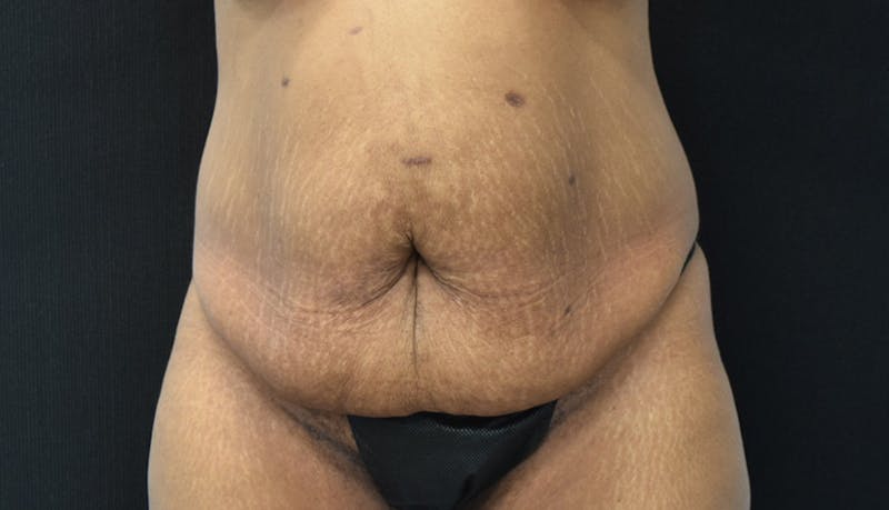 Massive Weight Loss Before & After Gallery - Patient 102563737 - Image 1