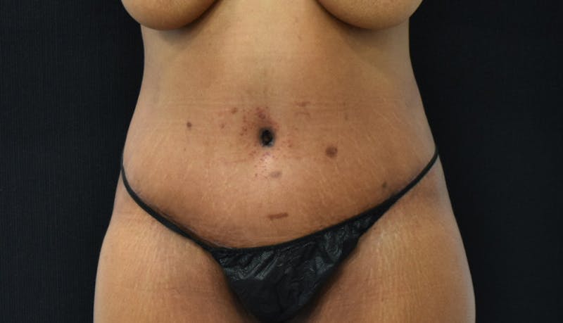 Massive Weight Loss Gallery - Patient 102563737 - Image 2