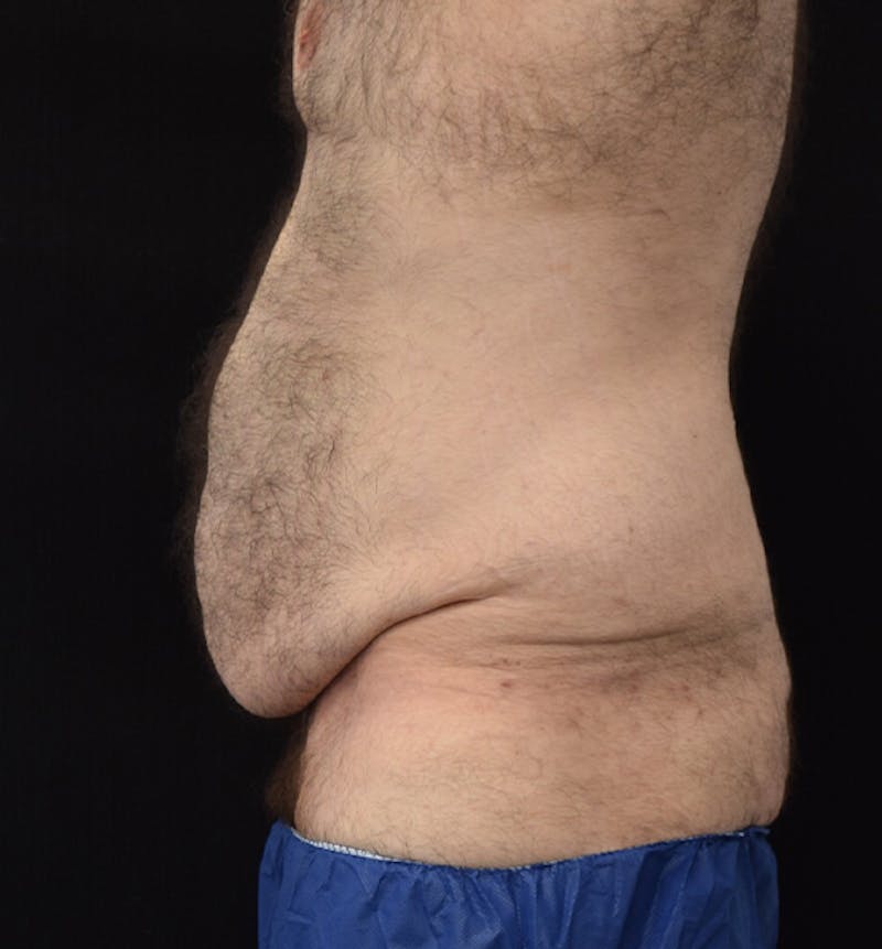 Male Lower Body Lift Before & After Gallery - Patient 148037528 - Image 9