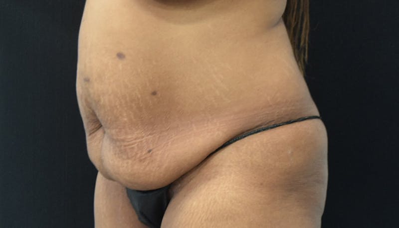 Massive Weight Loss Before & After Gallery - Patient 102563737 - Image 3