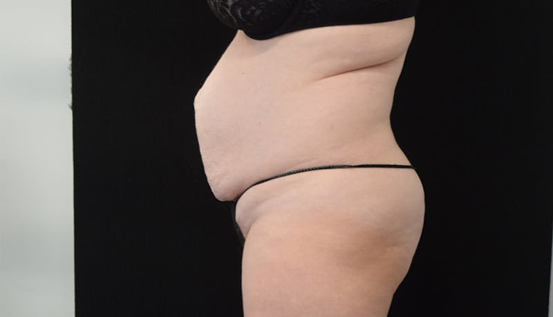 Abdominoplasty Before & After Gallery - Patient 102563751 - Image 6