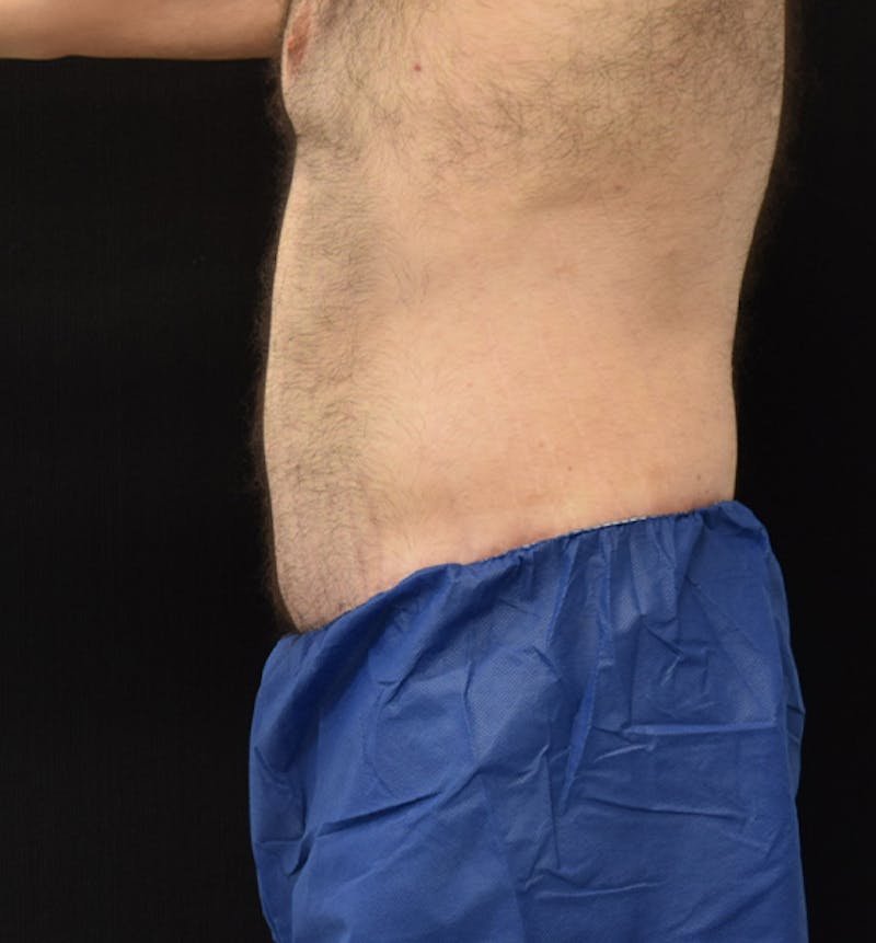 Male Lower Body Lift Before & After Gallery - Patient 148037528 - Image 10