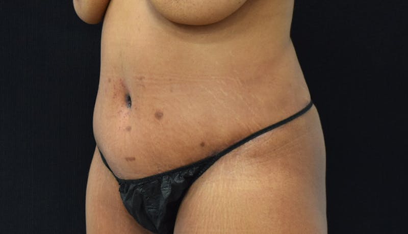 Massive Weight Loss Before & After Gallery - Patient 102563737 - Image 4