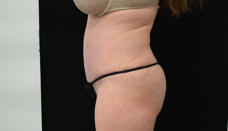Abdominoplasty Before & After Gallery - Patient 102563751 - Image 7