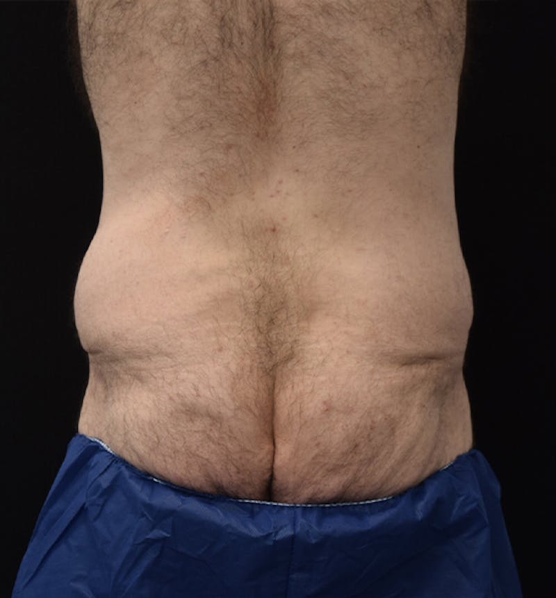 Male Lower Body Lift Before & After Gallery - Patient 148037528 - Image 11