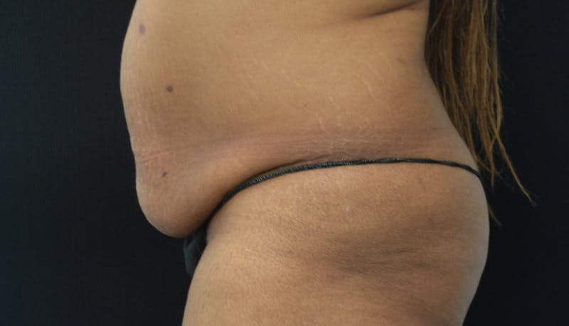 Massive Weight Loss Gallery - Patient 102563737 - Image 5