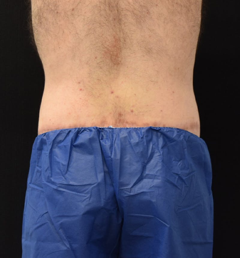 Male Lower Body Lift Before & After Gallery - Patient 148037528 - Image 12