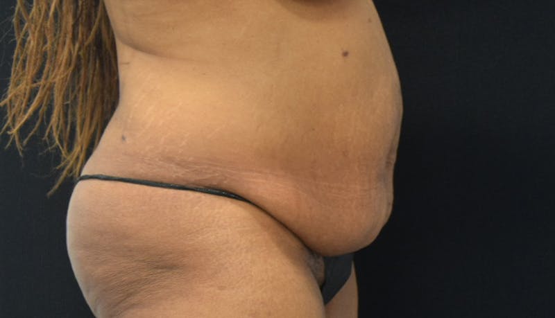 Massive Weight Loss Before & After Gallery - Patient 102563737 - Image 8