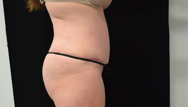 Abdominoplasty Before & After Gallery - Patient 102563751 - Image 8