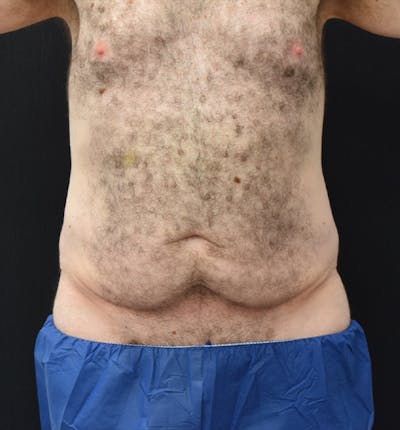 Male Lower Body Lift Before & After Gallery - Patient 148037529 - Image 1
