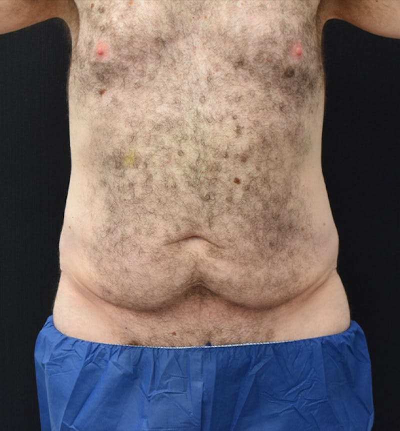Male Lower Body Lift Before & After Gallery - Patient 148037529 - Image 1