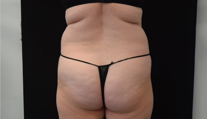 Abdominoplasty Before & After Gallery - Patient 102563751 - Image 9