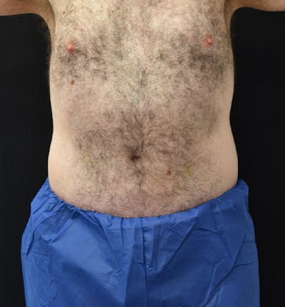 Male Lower Body Lift Before & After Gallery - Patient 148037529 - Image 2