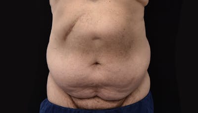 Massive Weight Loss Before & After Gallery - Patient 102563759 - Image 1