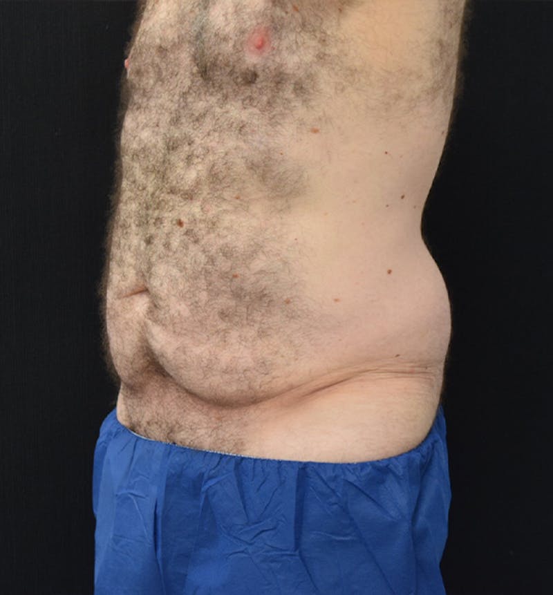 Male Lower Body Lift Before & After Gallery - Patient 148037529 - Image 3