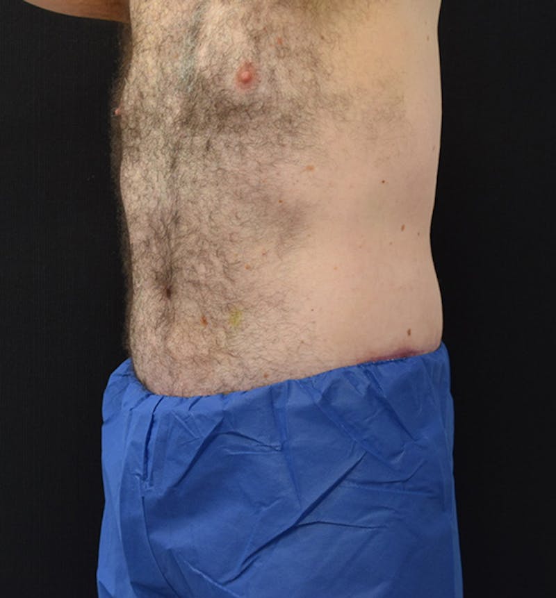 Male Lower Body Lift Before & After Gallery - Patient 148037529 - Image 4