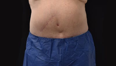 Massive Weight Loss Before & After Gallery - Patient 102563759 - Image 2