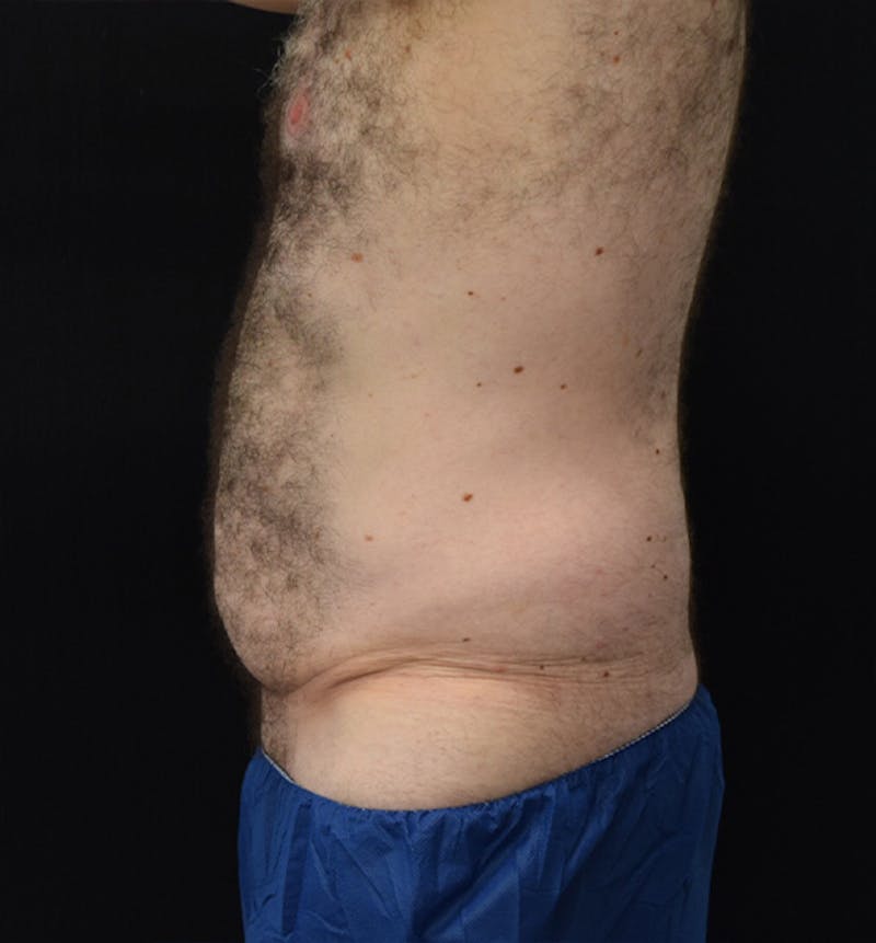 Male Lower Body Lift Before & After Gallery - Patient 148037529 - Image 5