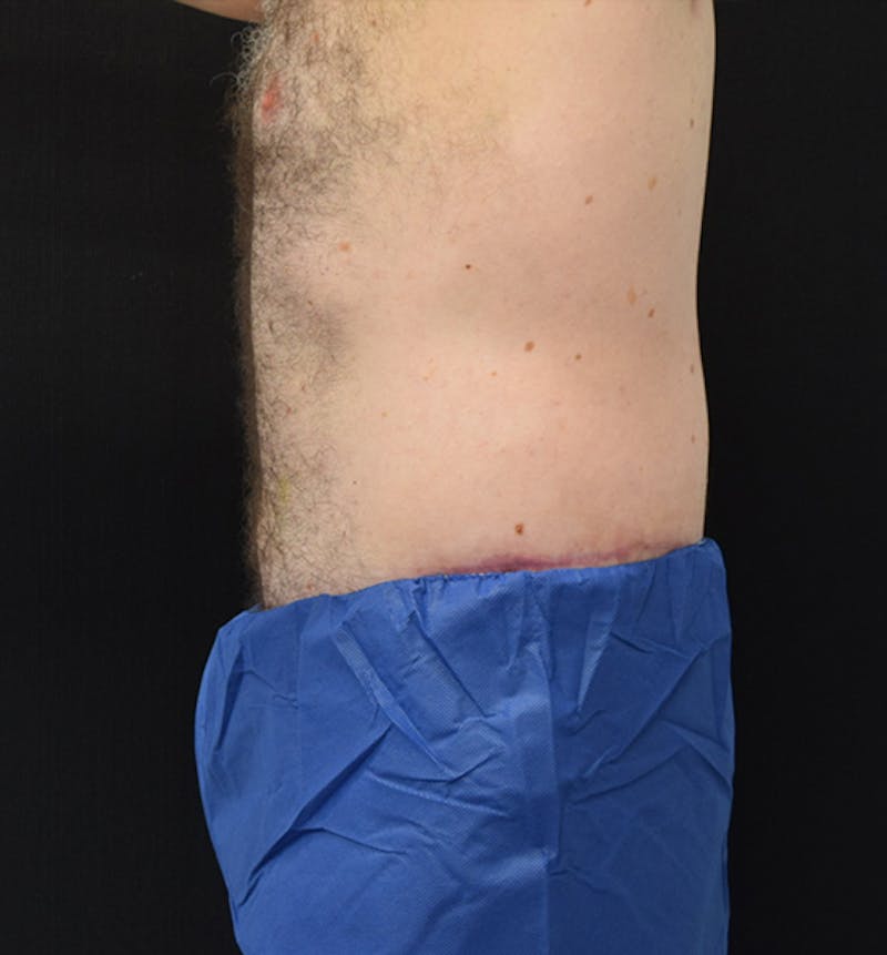 Male Lower Body Lift Before & After Gallery - Patient 148037529 - Image 6