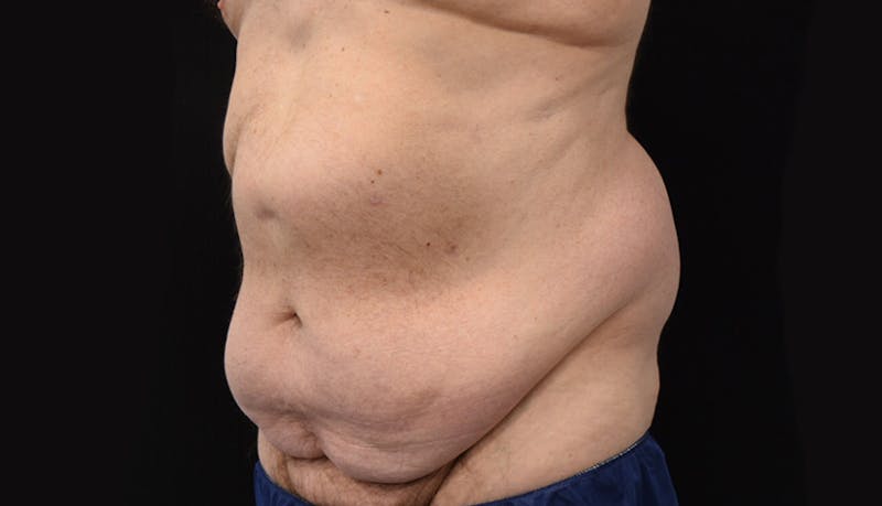 Massive Weight Loss Before & After Gallery - Patient 102563759 - Image 3