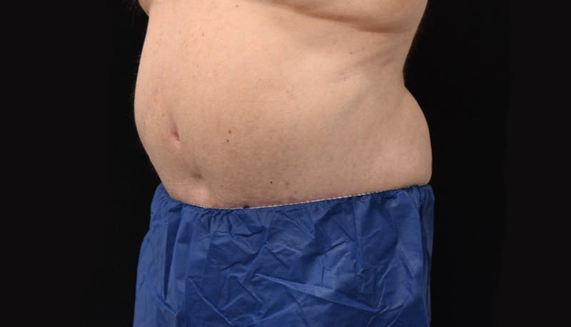 Massive Weight Loss Before & After Gallery - Patient 102563759 - Image 4