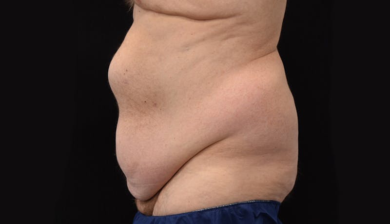 Massive Weight Loss Before & After Gallery - Patient 102563759 - Image 5