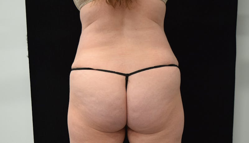 Abdominoplasty Before & After Gallery - Patient 102563751 - Image 10