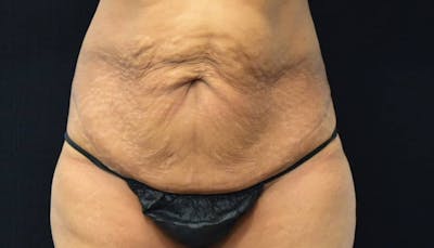 Abdominoplasty Before & After Gallery - Patient 102564048 - Image 1