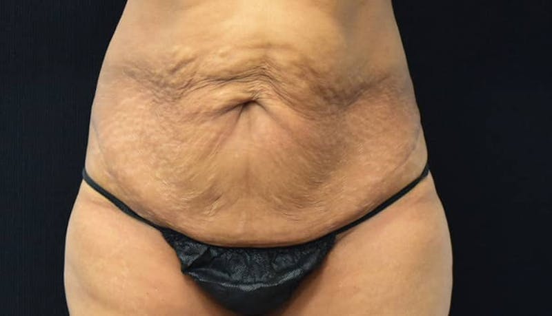 Abdominoplasty Before & After Gallery - Patient 102564048 - Image 1