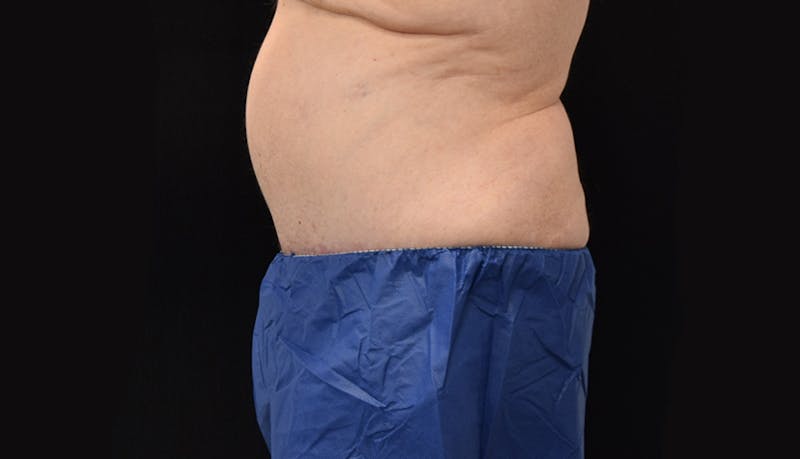 Massive Weight Loss Gallery - Patient 102563759 - Image 6