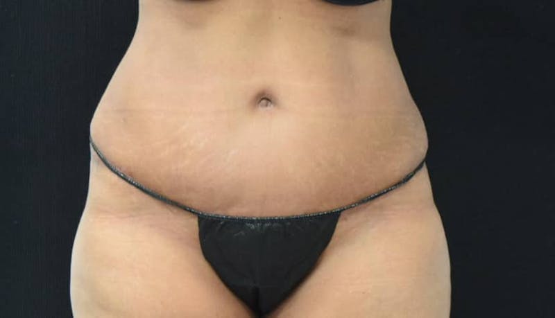 Abdominoplasty Before & After Gallery - Patient 102564048 - Image 2